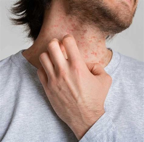 The Top 5 Dyshidrotic Eczema Medicines That Will Give You Beautiful