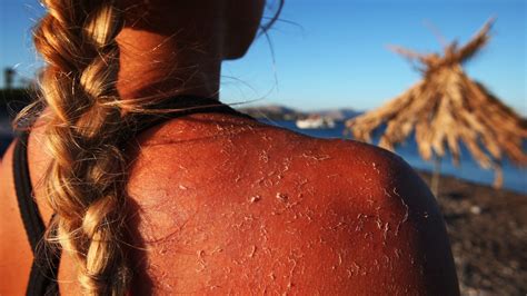 The Easy Sunburn Treatment That Kept My Skin From Peeling Glamour