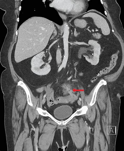 Cureus Abdominal Pain In A Patient With Giant Cell Arteritis
