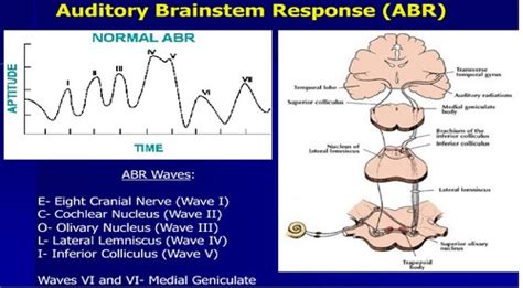 Auditory Brainstem Response Flashcards Quizlet