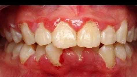 Gingivitis 3 Home Remedies To Get Rid Of This Gum Disease Article