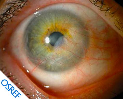 Corneal Pannus A Photographic Review Eyedolatry