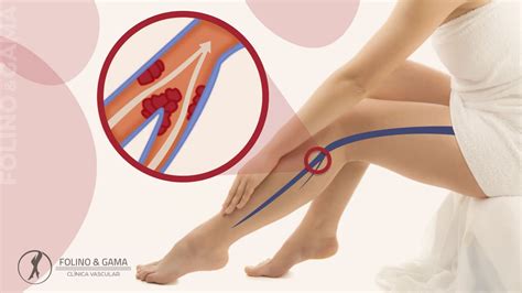 Trombose Causas Sintomas Tratamento E Preven O Folino Gama