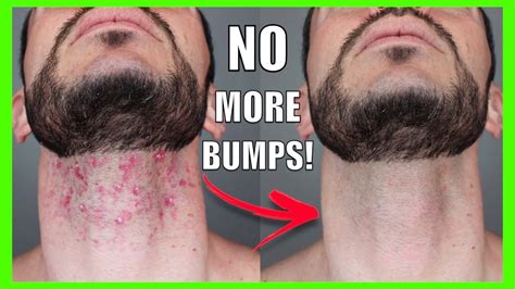 How To Get Rid Of Razor Bumps And Ingrown Hair Fast Face Body And Bikini Area Hack Youtube
