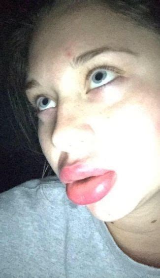 The Kylie Jenner Lip Challenge Has Turned Into A Complete Disaster 19