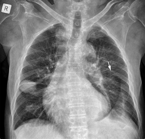 The Fissures Of The Lung Wikiradiography