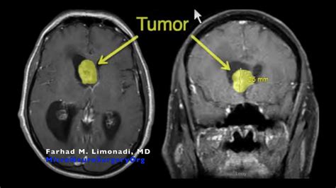 Brain Surgery Large Tumor Resection From Lateral Ventricle By