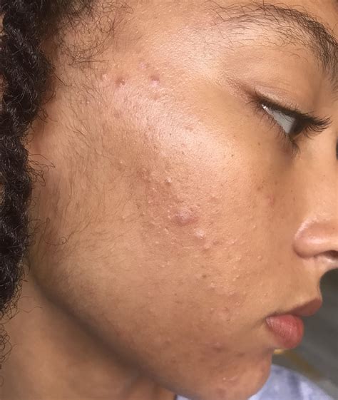 Face Oil For Acne Prone Skin Reddit