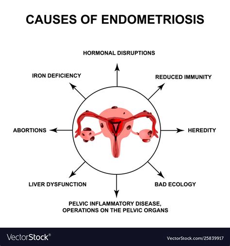 Theories on the pathogenesis of endometriosis. Causes endometriosis adenomyosis the Royalty Free Vector