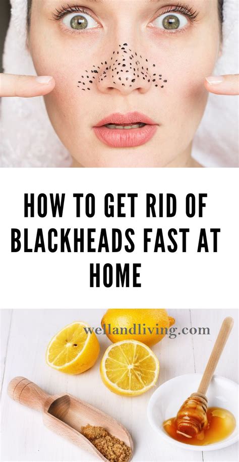 How To Get Rid Of Blackheads Moles And Warts Fast At Home Get Rid Of