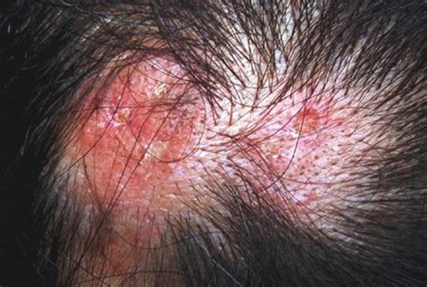 Red Bumps On Scalp Hair Loss Causes And Treatments In 2023