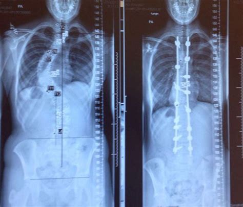 Before And After Scoliosis Surgery Scoliosis X Ray Scoliosis Treatment