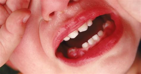 Swollen Gums In An Infant Livestrongcom