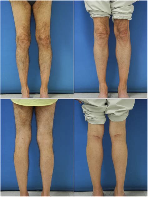 Calf Implants Dr G Cosmetic Surgery