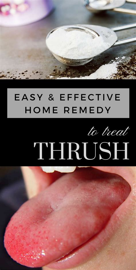 Easy And Effective Home Remedy To Treat Thrush With Images Home