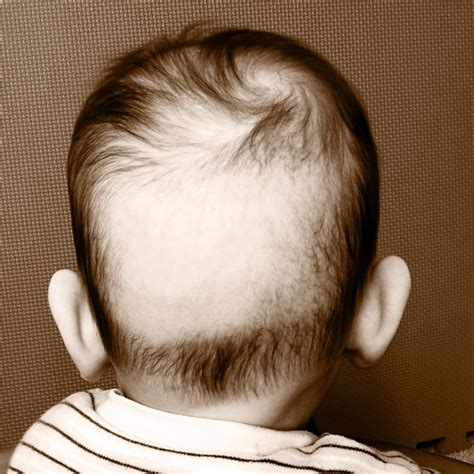 Collection 95 Images Bald Spot On Baby Head From Sleeping Stunning