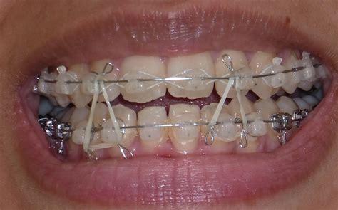 You can eat any kind of chips with braces, but be careful! My Damon Clear Braces: Week 21 - Wire change to 'square ...