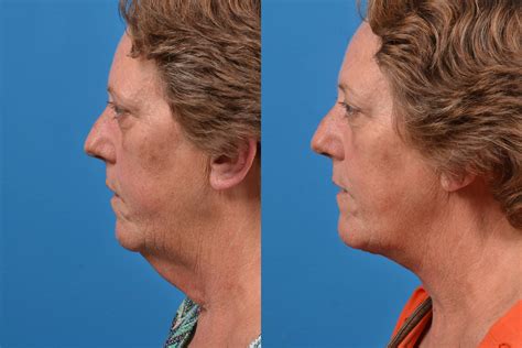 Patient 122406433 Profile Neck Lift Before And After Photos Clevens