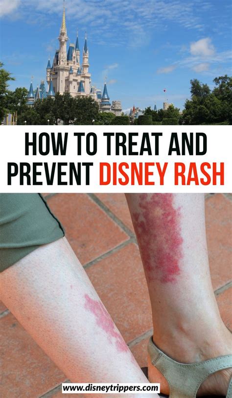 How To Treat And Prevent Disney Rash Disney Trippers In 2020 Disney