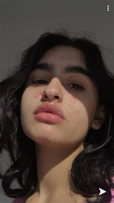 Apply to all the parts of your face affected by acne 20 minutes after washing your face. Pin by ☹︎ on yEs :) | Girl with acne, Model with skin ...
