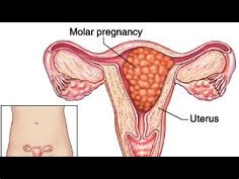 Molar Pregnancy Hydatidiform Mole Symptoms Sign Clinical Examination