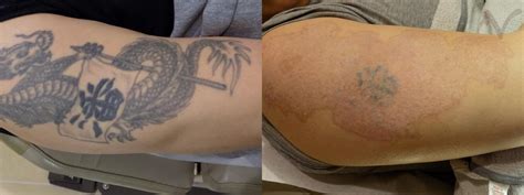 Top 100 Tattoo Removal Before And After Photos
