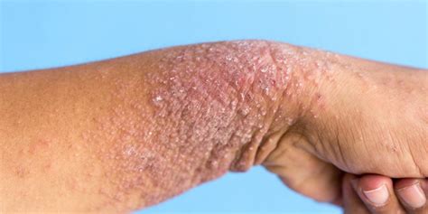 Dermatite Atopique Comment La Reconnaître Pour Mieux La Traiter