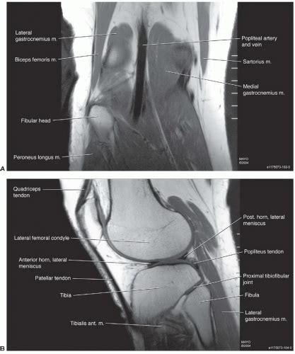 ► shoulder ► elbow ► wrist ► finger ► thumb. Knee Muscle Anatomy Mri : Mri Knee Anatomy Knee Sagittal ...