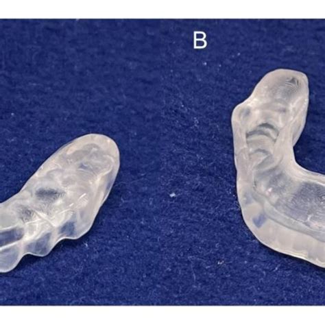 3d Printed Occlusal Splint A Occlusal Surface On Which Adjustment