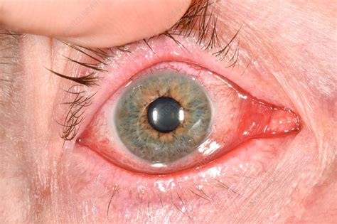 Viral Conjunctivitis Stock Image C0426379 Science Photo Library
