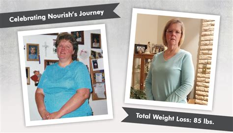 Before And After Rny With Nourish Losing 85lbs Obesityhelp