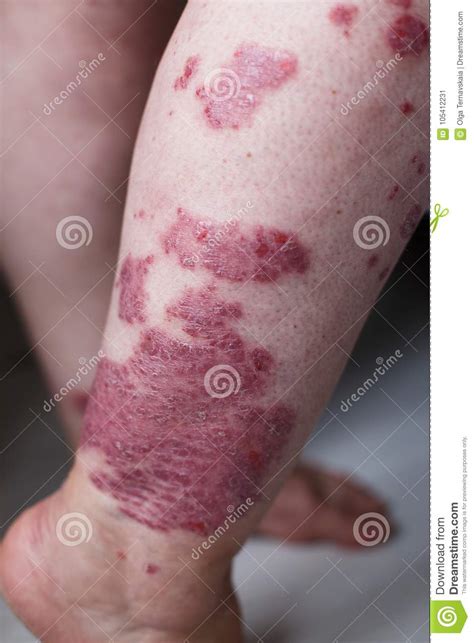 Allergic Rash Dermatitis Eczema Skin On Leg Of Patient Psoriasis And
