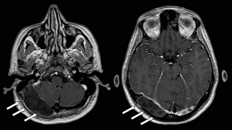 Intradiploic Epidermoid Cyst With Osteolytic Lesions Of The Skull