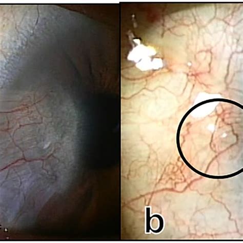 Superficial Keratectomy Involving Normal Corneal Epithelium Was