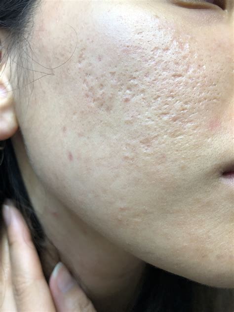 What Should I Do Acne Scars Scar Treatments