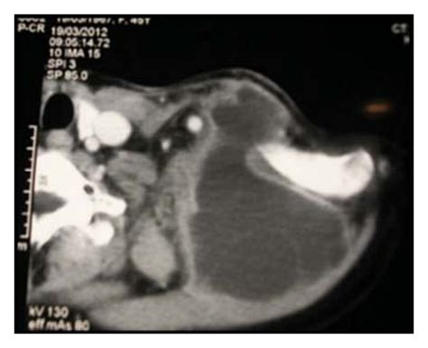 Ct Scan Demonstrated Cystic Structure In The Left Supraclavicular