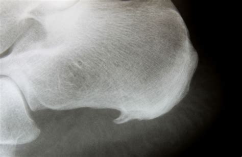 Heel Spur Surgery Is Used To Remove Painful Calcium Deposits On The