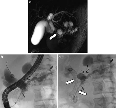 Stenting Of Pancreatic Duct Stricture And Biliary Stricture Coronal