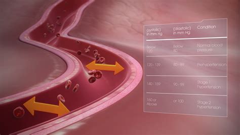 Hypertension Shown And Explained Using Medical Animation Still Shot