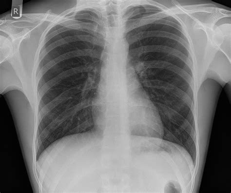 If you go to your doctor or the emergency room with chest pain, a. Normal chest radiograph (male) | Image | Radiopaedia.org