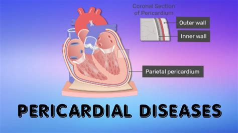 Pericardial Diseases Pericarditis Youtube