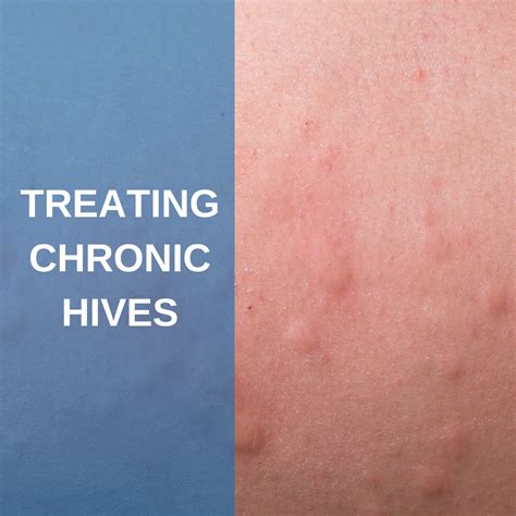 Chronic Hives And Other Hives Complications Everyday