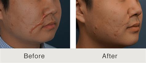 Before And After Facial Keloid Carolina Facial Plastics