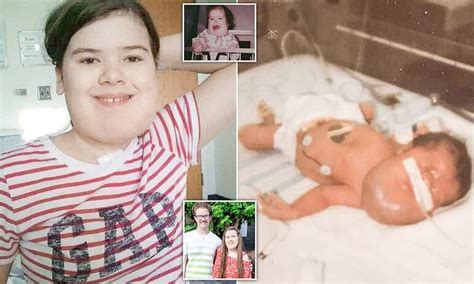 Teenager Born With A Facial Mass The Size Of Her Head Has 55 Surgeries