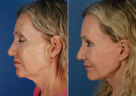 The Uplift™ Lower Face And Neck Lift Photos Naples Fl Patient 11239
