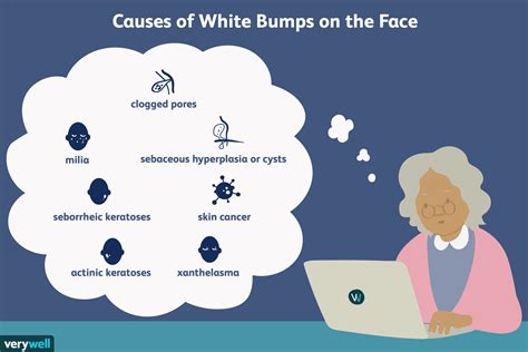 White Bumps On Face Milia And 7 Other Causes