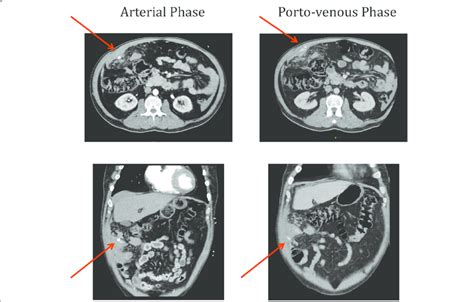 Ct Abdomenpelvis With Iv Contrast With Arterial And Porto Venous