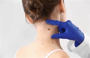 What You Need To Know About Mole Removal Dermatology Associates Of