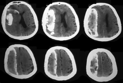 Calcified Chronic Subdural Hematoma Illustrative Case In Journal Of