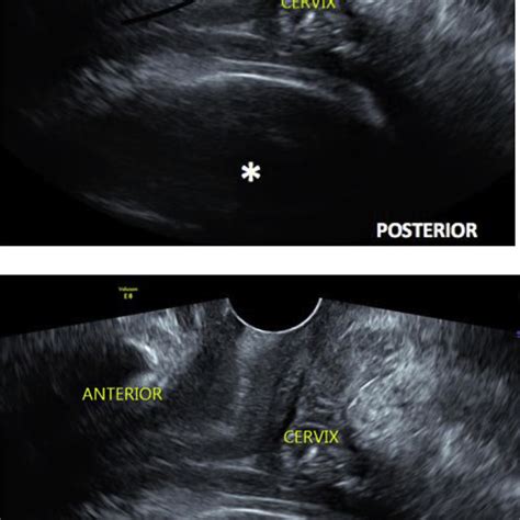 transvaginal ultrasound image 1 the black curve an elongated cervix hot sex picture